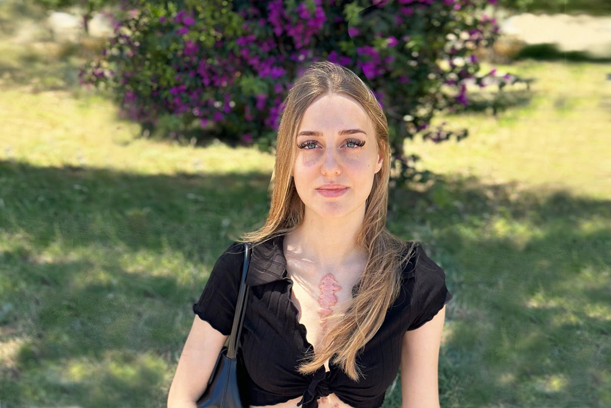 la cicatrice di Sonia, trapiantata di cuore