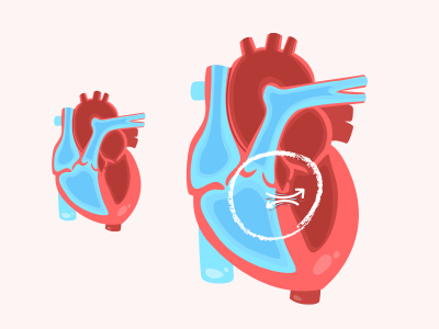 Rappresentazione tetralogia di Fallot: malformazione al cuore del piccolo Suleman che vorremmo salvare con un intervento